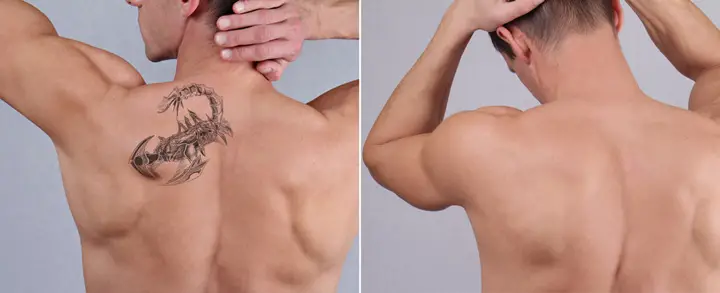 How to Hide and Remove Tattoo
